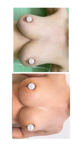 نمونه کار لیفت سینه و ماموپلاستی